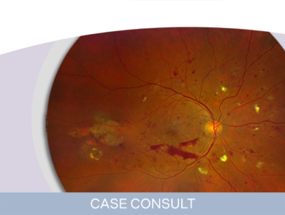 A Treatment-Naïve Patient With PDR and DME