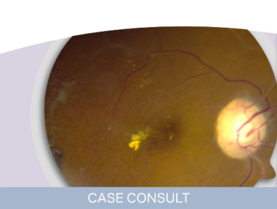 Recalcitrant DME Case