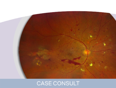 A Treatment-Naïve Patient With PDR and DME