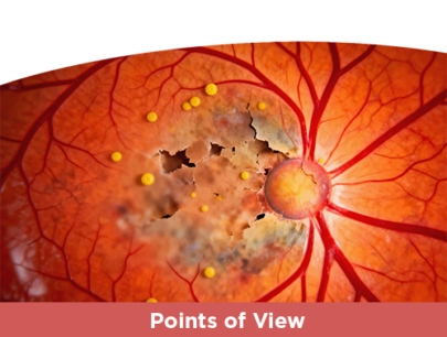 Switching IVT Anti-VEGF Agents for nAMD