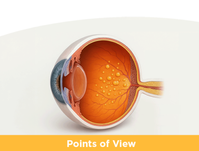 Managing Retinal Fluid in Wet AMD
